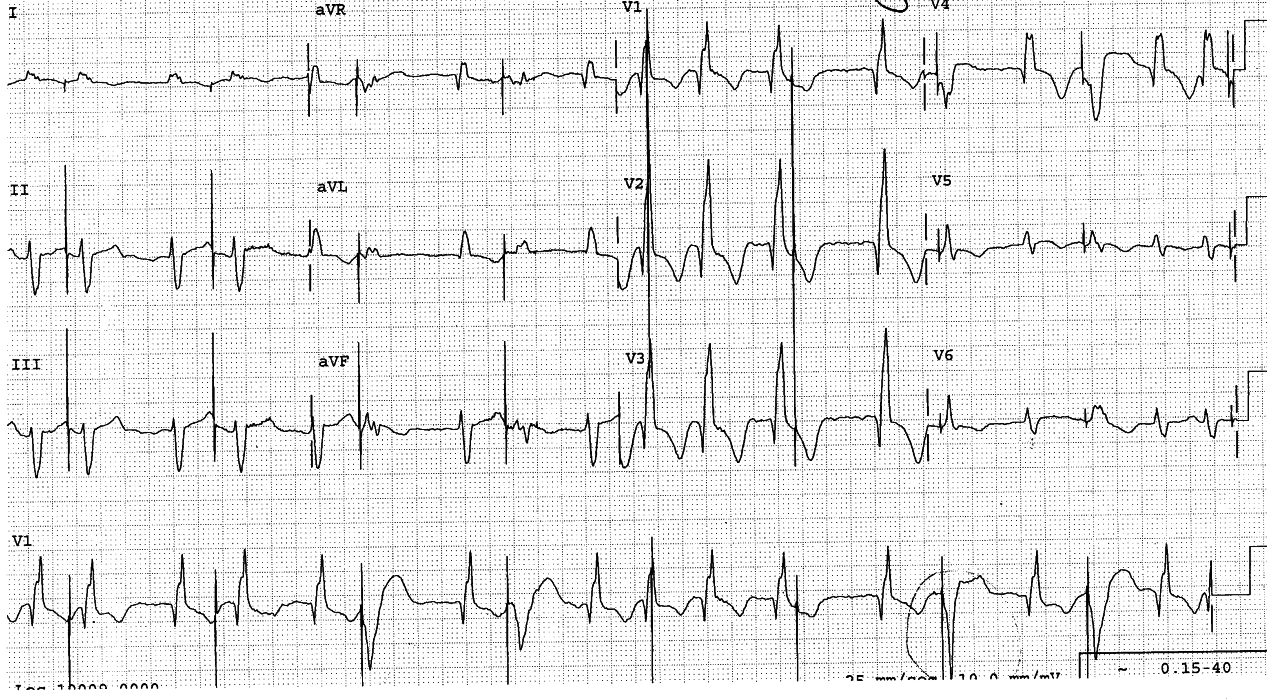 79 year old man in ICU following successful CABGs.