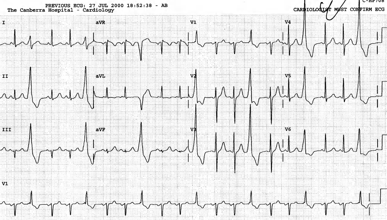 48 year old hypertensive man in Rehabilitation Department following a CVA. 