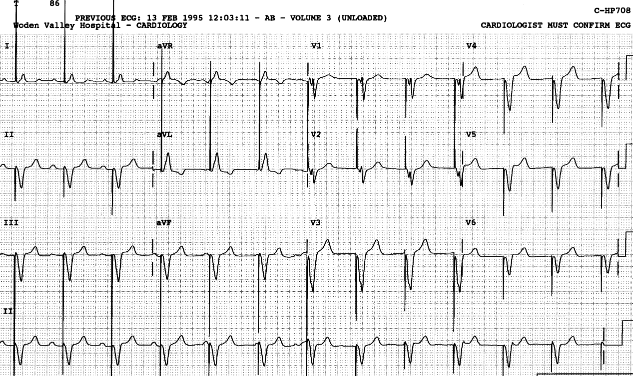 69 year old woman with history of syncope, well since
implantation of a permanent pacemaker. She is prone to reverse pulsus
paradoxus, but remains unaware of that.