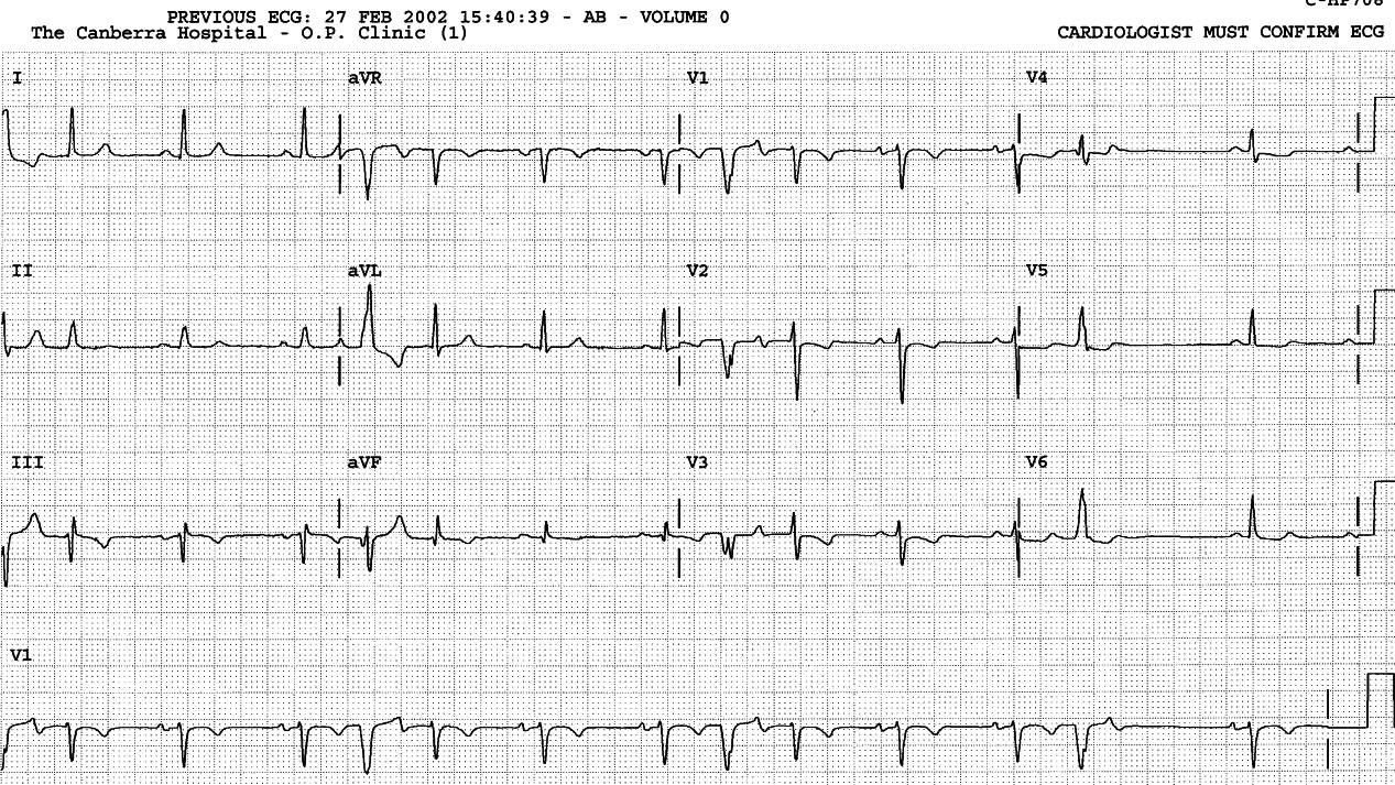 69 year old lady with ischÃ¦mic heart disease and     palpitations. 