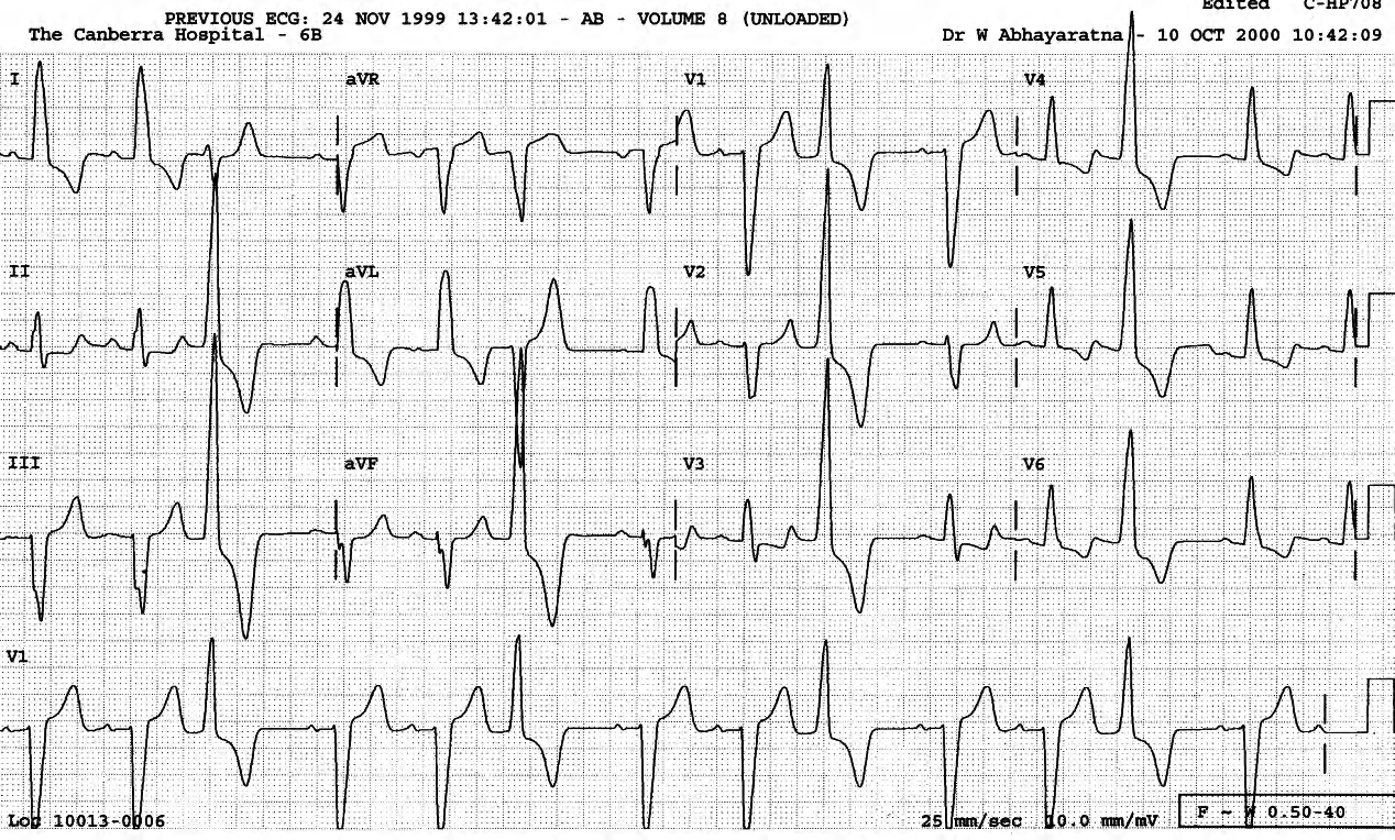 Positively concordant trigeminal VEBs in another patient. 