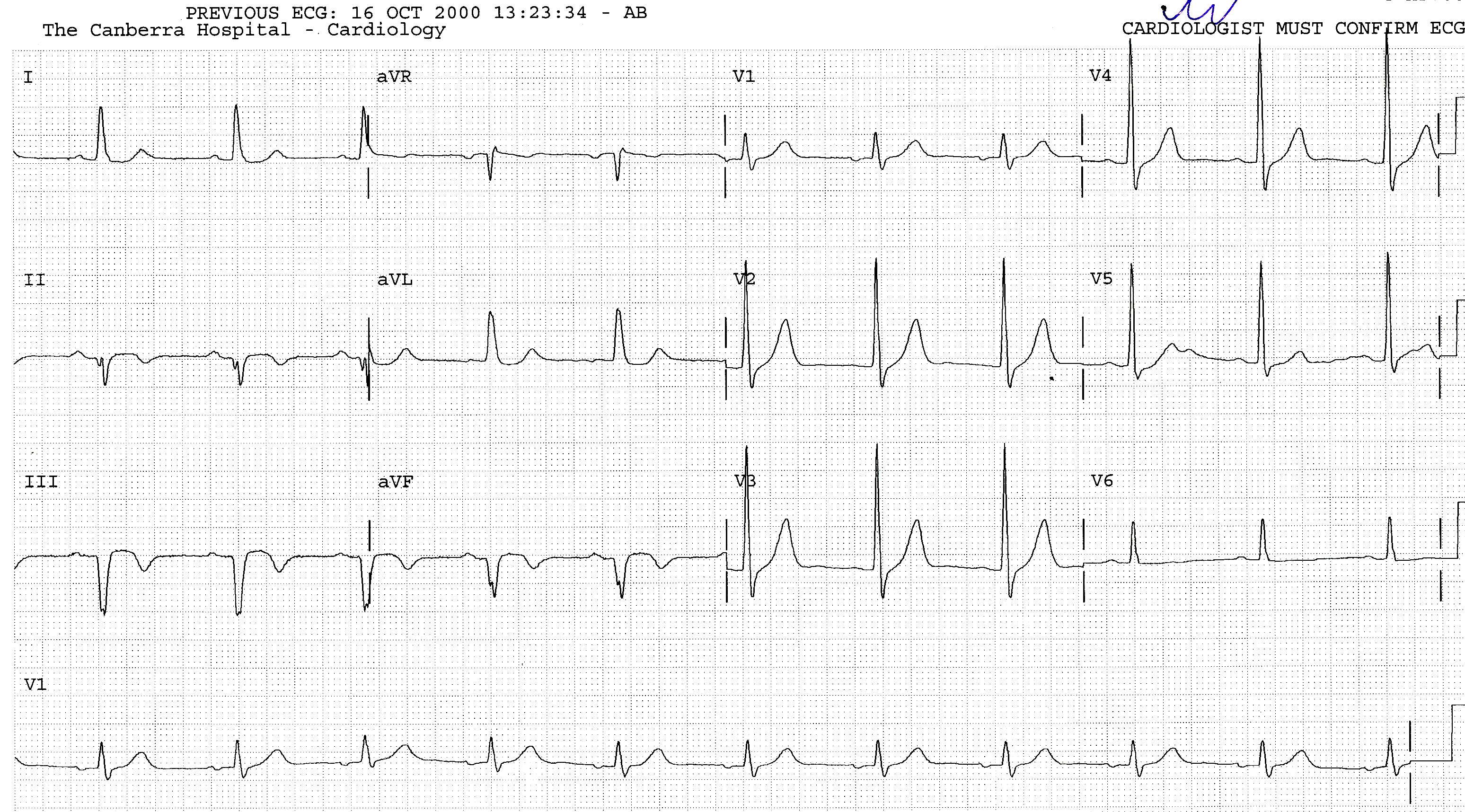 47 year old man with history of remote myocardial infarction, transferred from a country hospital after failed thrombolysis.