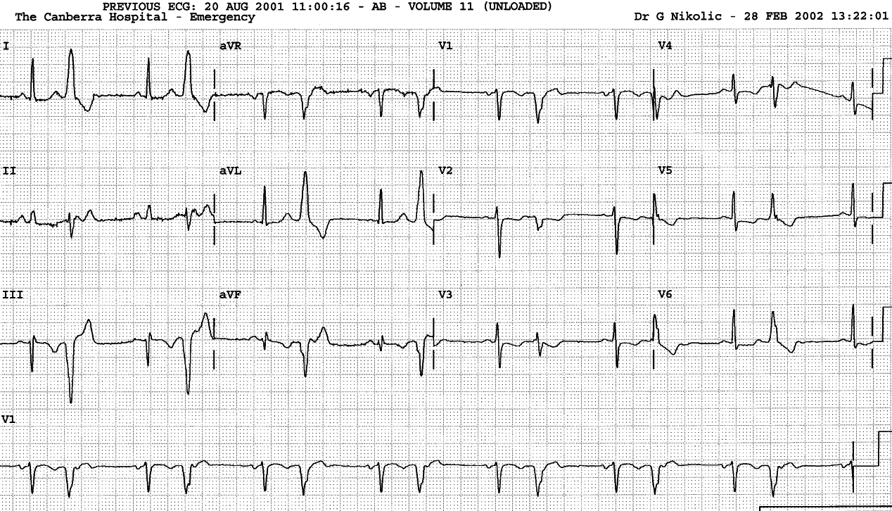 VEBs in bigeminy. 