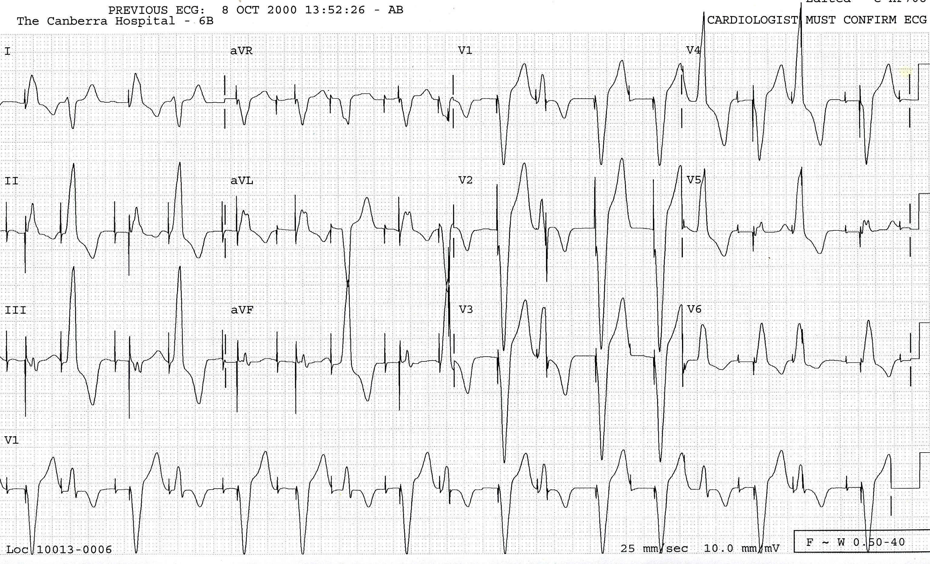 Same patient as in Fig 23a, with same VEBs, now decorated with redundant spikes from a malfunctioning pacemaker. 