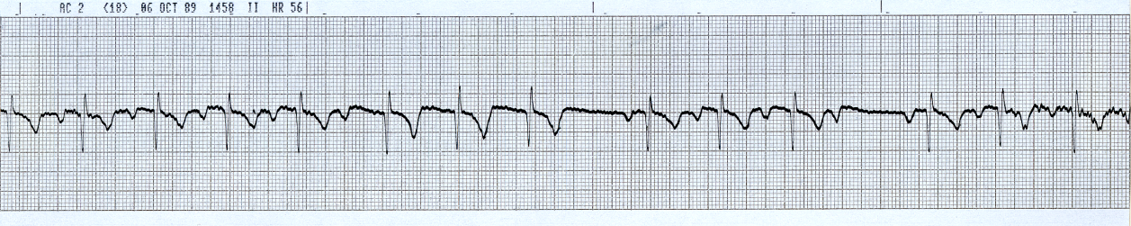 37 year old jogger with progressive exertional angina over 6 weeks. His 12-lead ECG is normal except for a 1o AV block. He remains asymptomatic during the recording shown below. 