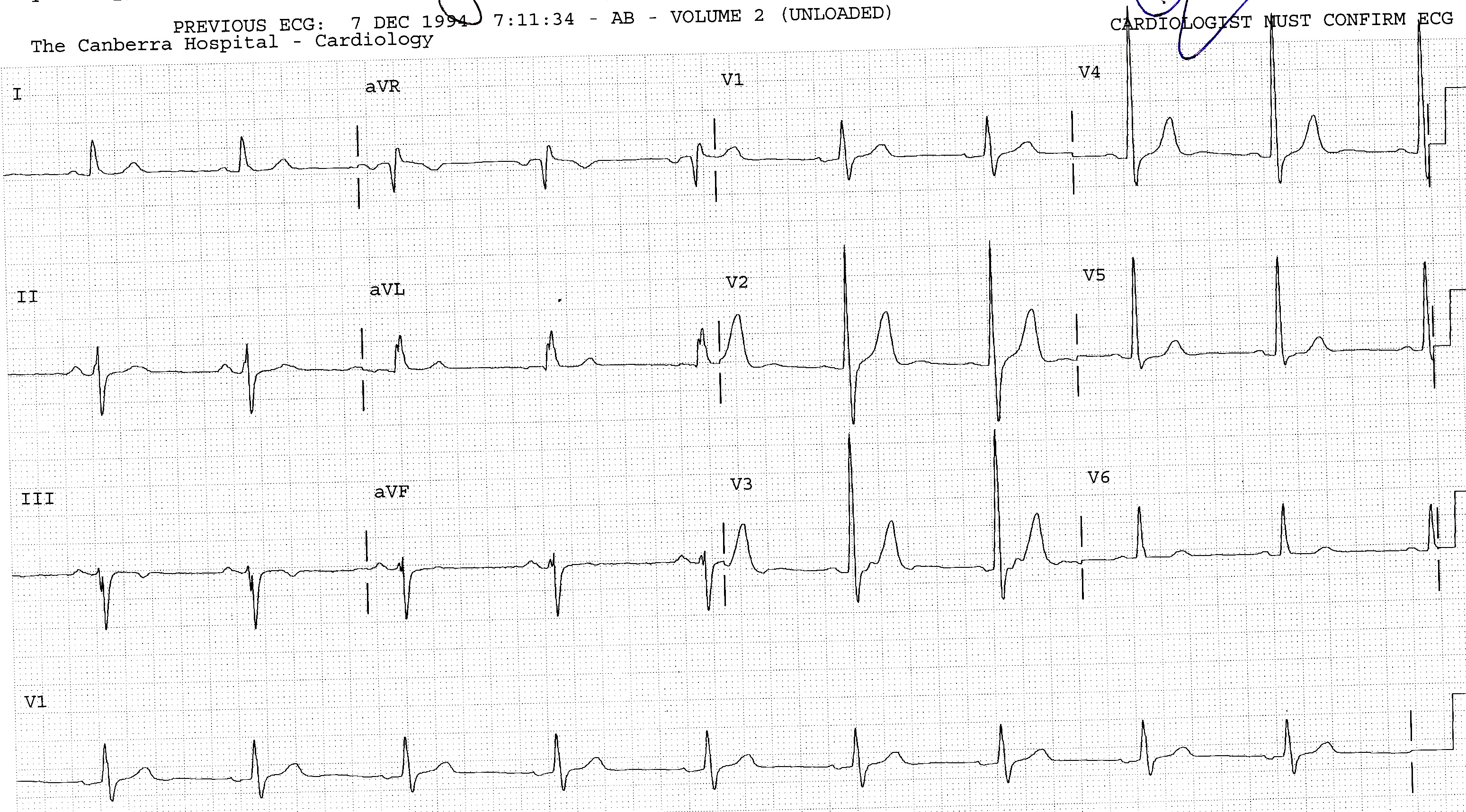 True posterior infarction and LAHB.