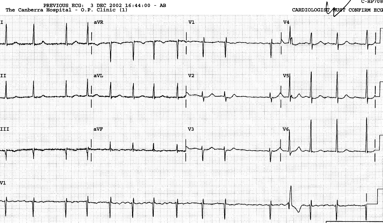 70 year old lady with history of angina and hypertension, in CCU