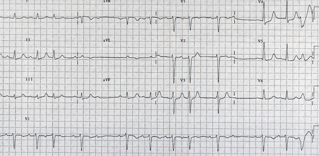 Further instances of SVEBs causing AVB âat a distanceâ. The     âpost-ectopicâ T wave change is, of course, due to the pause rather than     (actually remote) SVEB. 