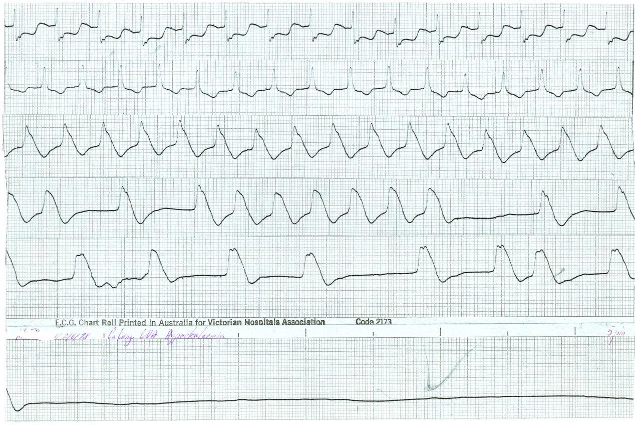 Different patient; ST depression, then elevation.