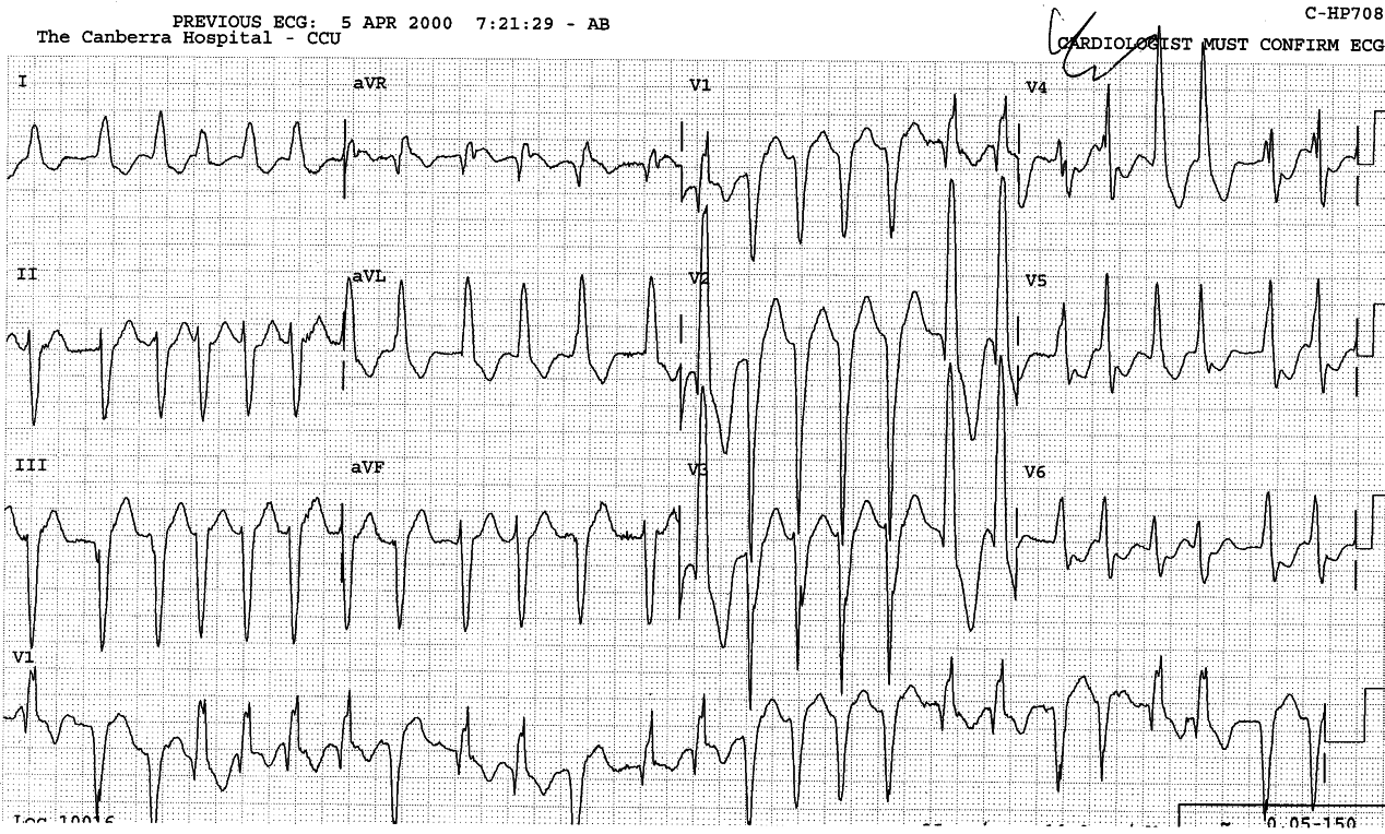 The masquerading BBB in standard leads: RBBB and LBBB beats
are almost indistinguishable. V1 strip is indispensable.