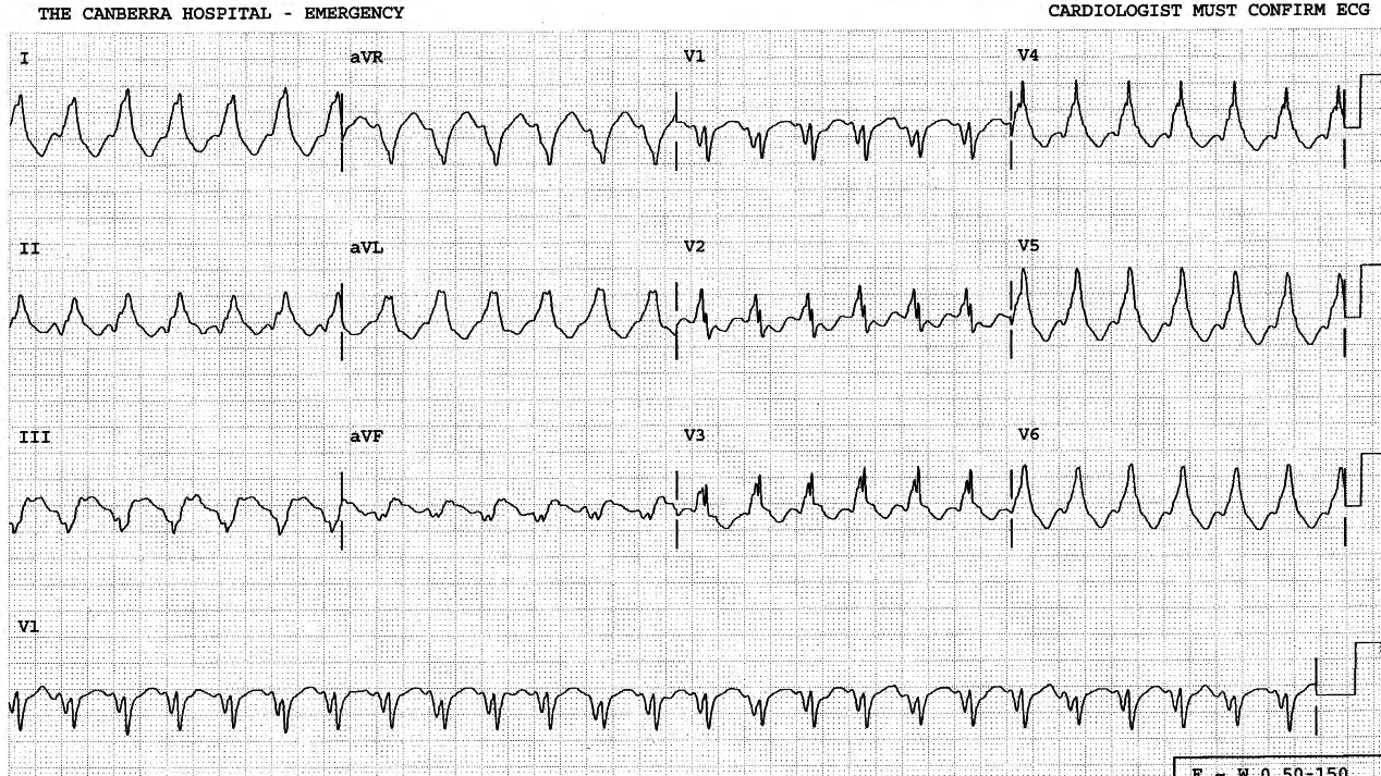 A 57 year old man recently fitted with a cardioverter-defibrillator (ICD) and on oral sotalol therapy for recurrent tachycardia. He is hypotensive in pulmonary Ådema in Casualty. 