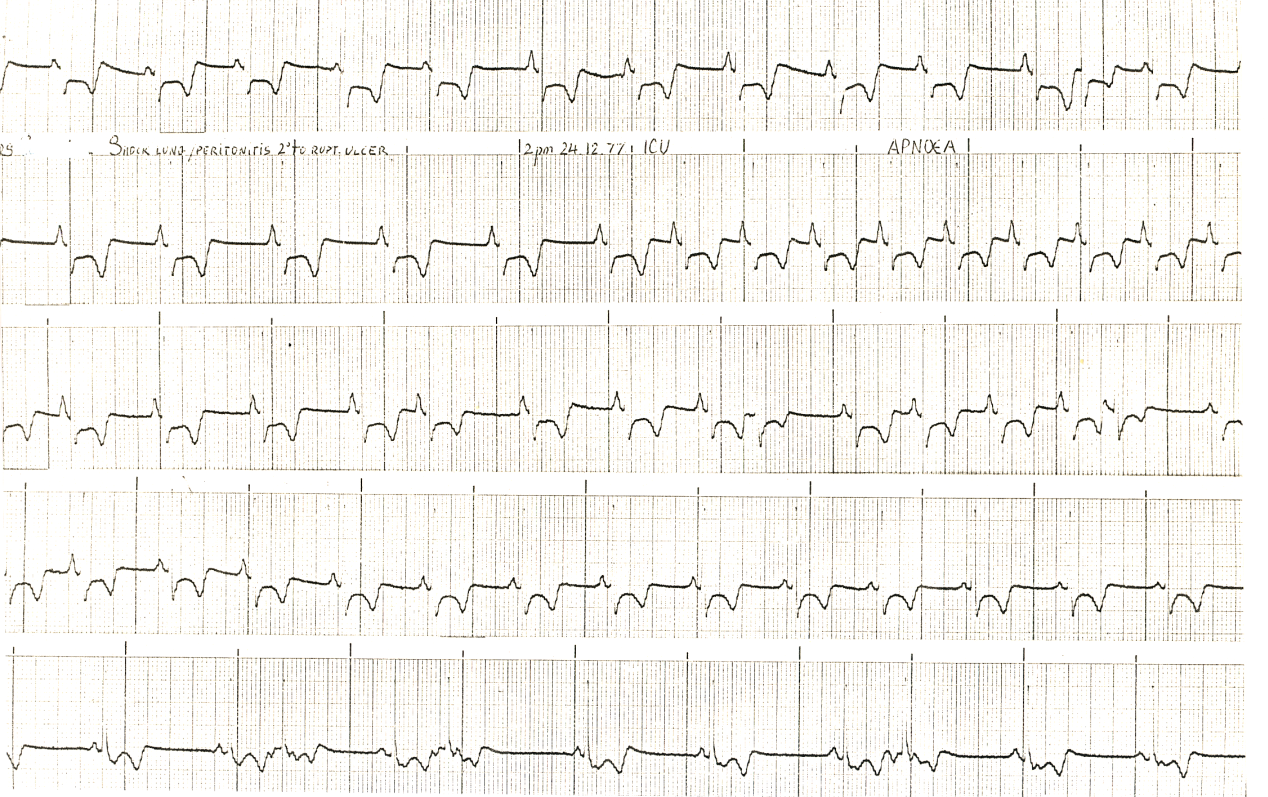 Different patient. Initial ST segment depression.