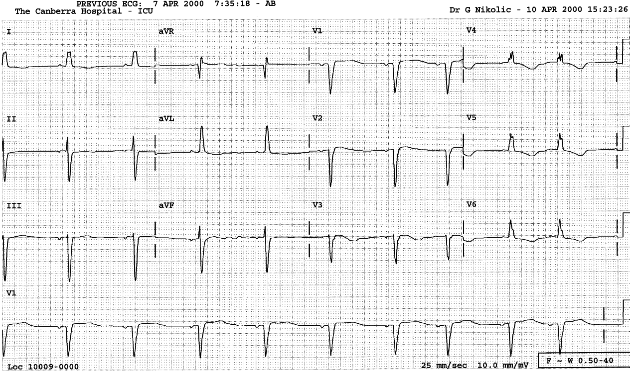 LBBB conduction in sinus rhythm.